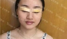 做双眼皮手术，身体影响与术后护理