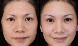 双眼皮手术，安全与风险的权衡