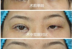 双眼皮手术后的后遗症，了解风险与预防措施