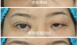 双眼皮手术后的后遗症，了解风险与预防措施