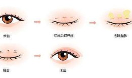 双眼皮手术的风险与可能的后遗症