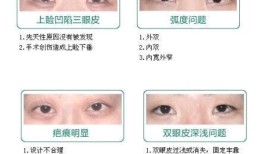 双眼皮手术的潜在副作用及其预防措施