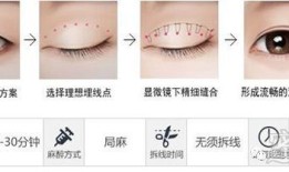 双眼皮手术的风险与可能的后遗症