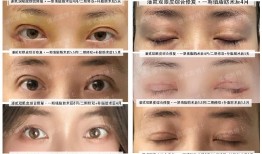 双眼皮手术后遗症，视频讲解与专业分析