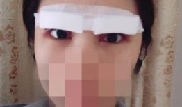 做双眼皮手术，后果、风险与恢复过程