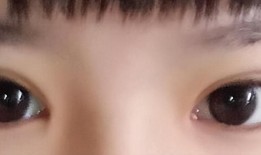 做双眼皮手术，身体影响与术后护理