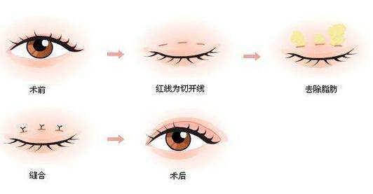 双眼皮手术的风险与可能的后遗症