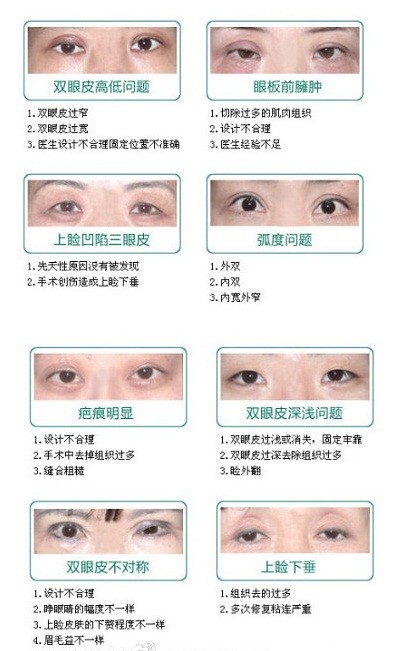 双眼皮手术的风险与可能的后遗症